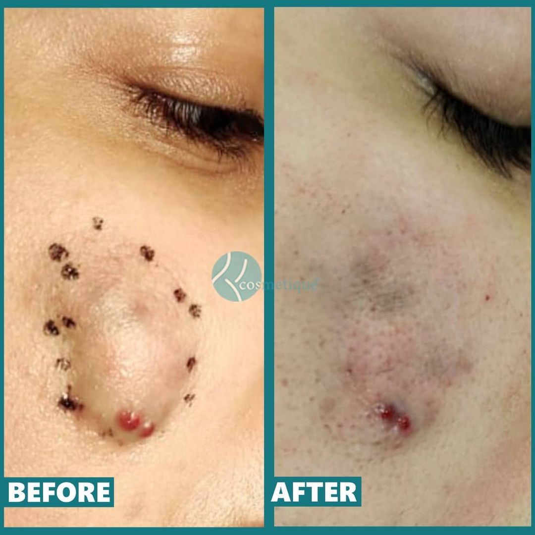 Acne Treatment in Lahore, best pimple treatment in lahore