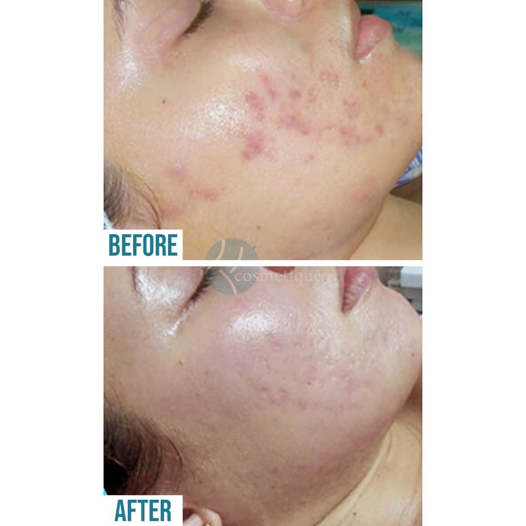 acne scars removal treatment in lahore