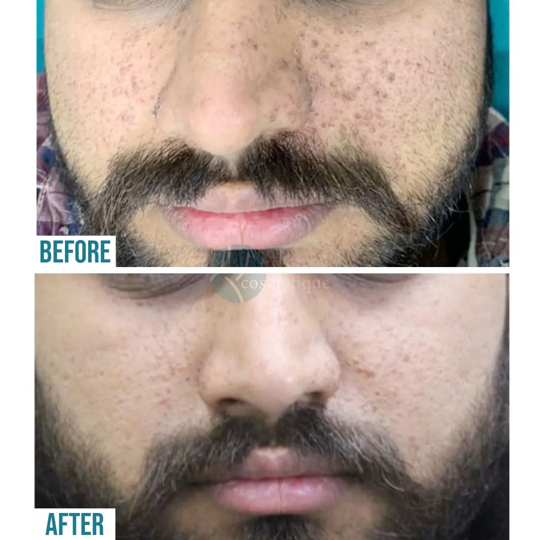 acne scars removal treatment in Lahore