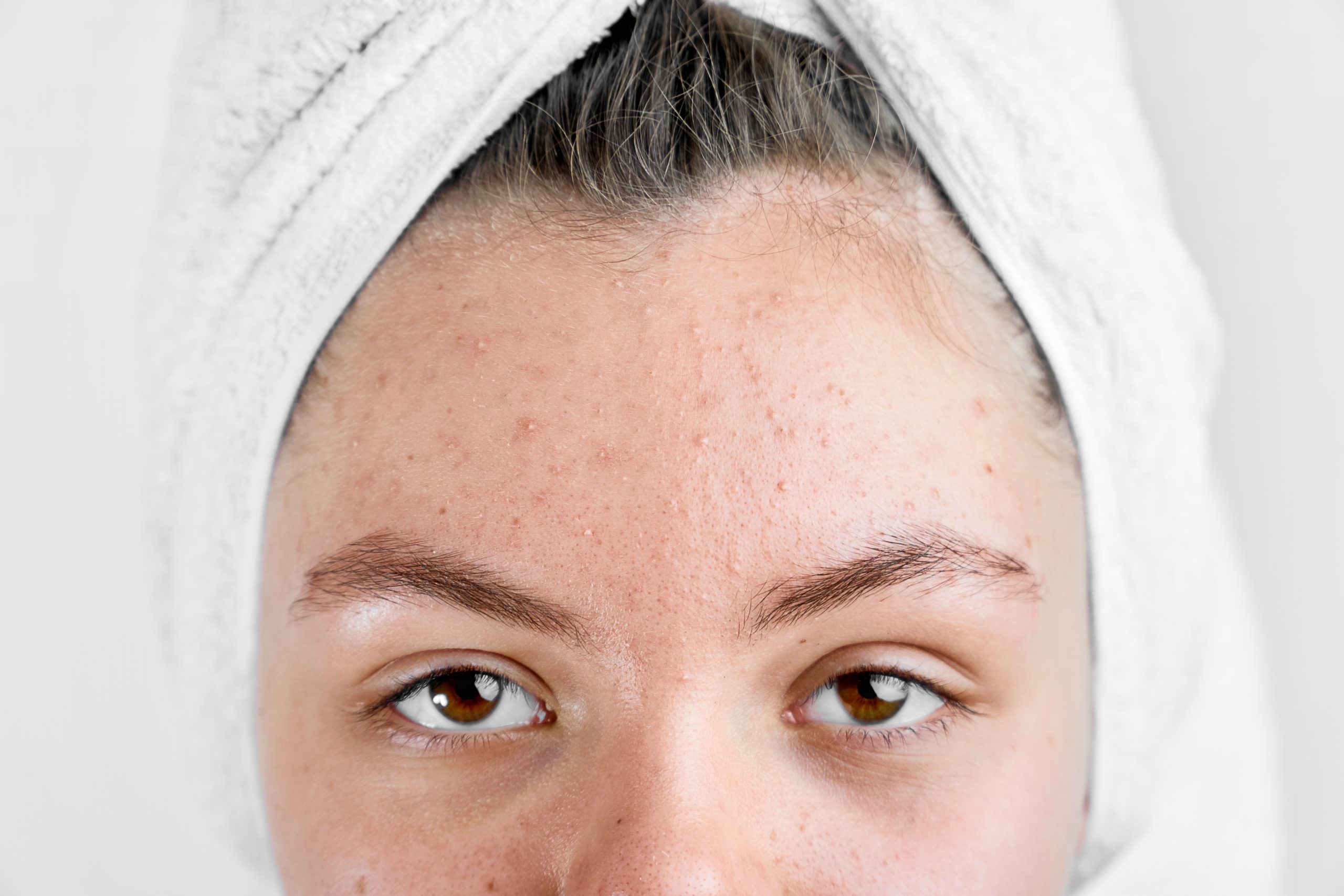 Acne Treatment