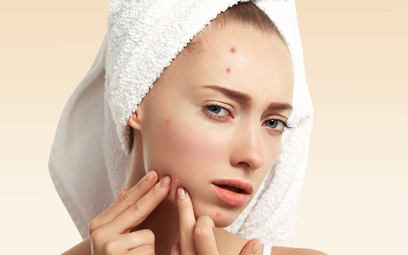 Best acne treatment in Lahore