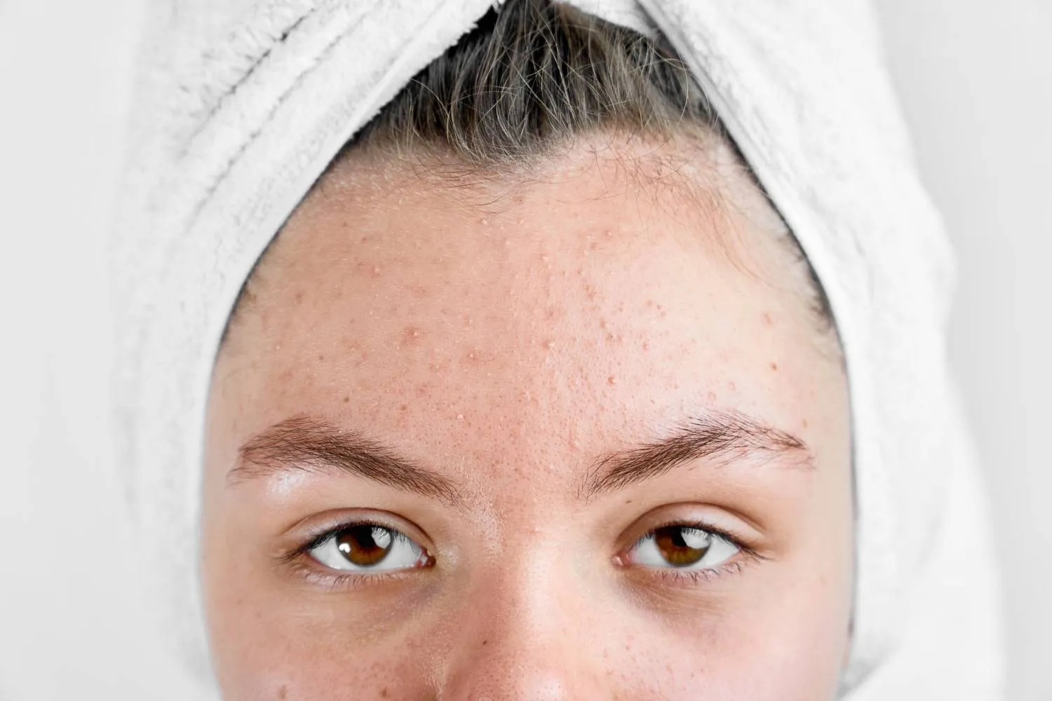Acne Treatment