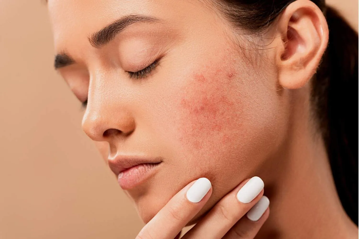 Acne Treatment