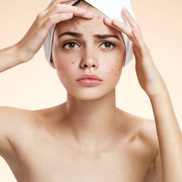 Acne treatment in lahore