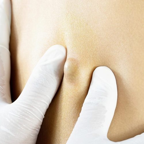 Cysts removal treatment in Lahore