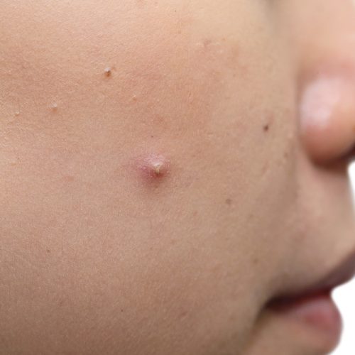 acne treatment in lahore, pimple treatment in dha