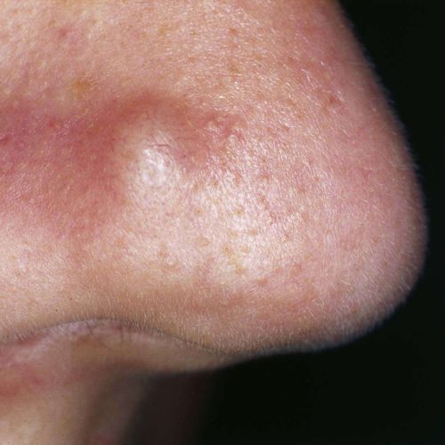 papules